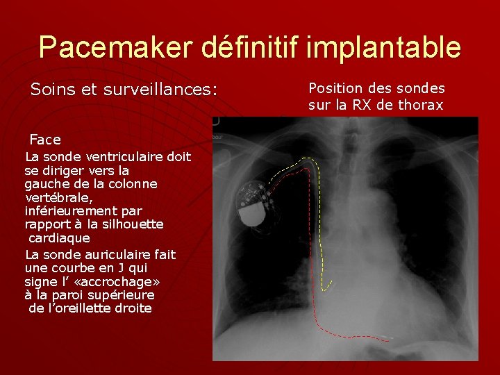 Pacemaker définitif implantable Soins et surveillances: Face La sonde ventriculaire doit se diriger vers