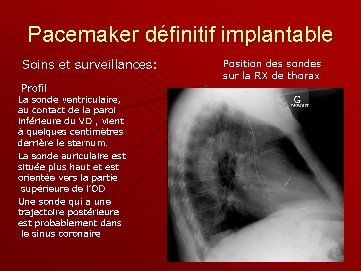 Pacemaker définitif implantable Soins et surveillances: Profil La sonde ventriculaire, au contact de la