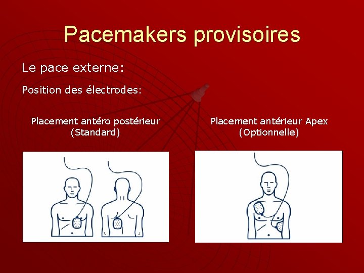 Pacemakers provisoires Le pace externe: Position des électrodes: Placement antéro postérieur (Standard) Placement antérieur