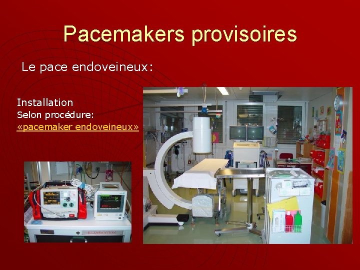 Pacemakers provisoires Le pace endoveineux: Installation Selon procédure: «pacemaker endoveineux» 