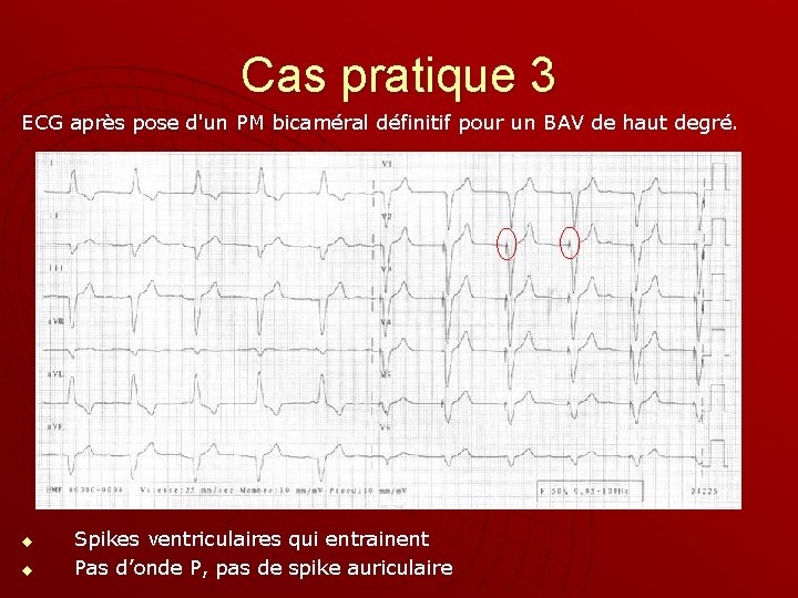 Cas pratique 3 ECG après pose d'un PM bicaméral définitif pour un BAV de