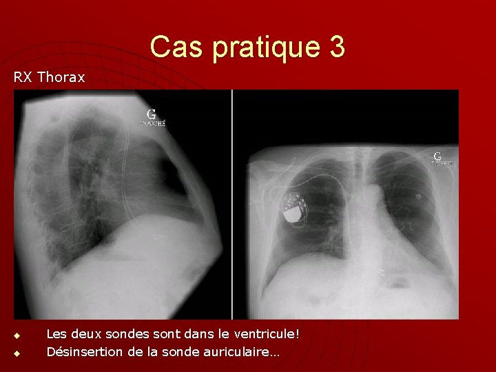 Cas pratique 3 RX Thorax u u Les deux sondes sont dans le ventricule!
