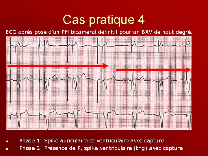 Cas pratique 4 ECG après pose d'un PM bicaméral définitif pour un BAV de