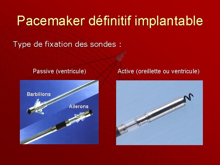 Pacemaker définitif implantable Type de fixation des sondes : Passive (ventricule) Barbillons Ailerons Active