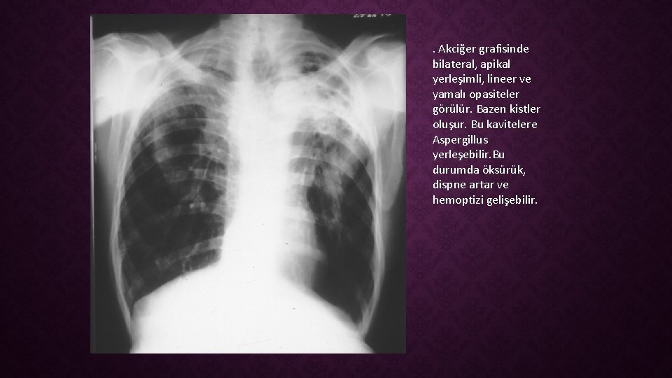 . Akciğer grafisinde bilateral, apikal yerleşimli, lineer ve yamalı opasiteler görülür. Bazen kistler oluşur.