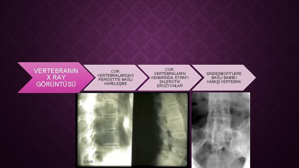 VERTEBRANIN X RAY GÖRÜNTÜSÜ COR. VERTEBRALARDAKİ PERİOSTİTE BAĞLI KARELEŞME COR. VERTEBRALARIN KENARINDA, ETRAFI SKLEROTİK