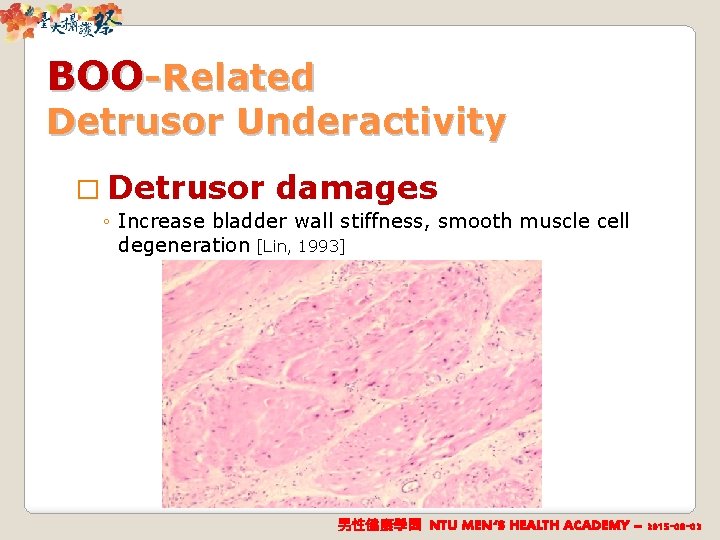 BOO-Related Detrusor Underactivity � Detrusor damages ◦ Increase bladder wall stiffness, smooth muscle cell