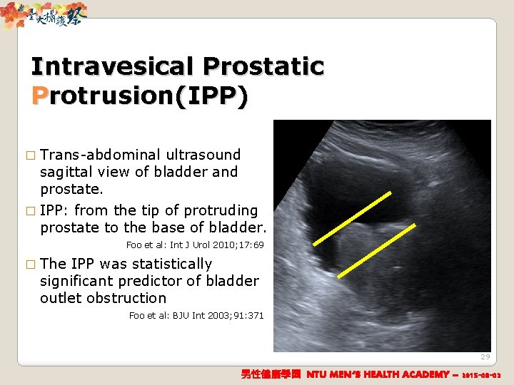 Intravesical Prostatic Protrusion(IPP) � Trans-abdominal ultrasound sagittal view of bladder and prostate. � IPP: