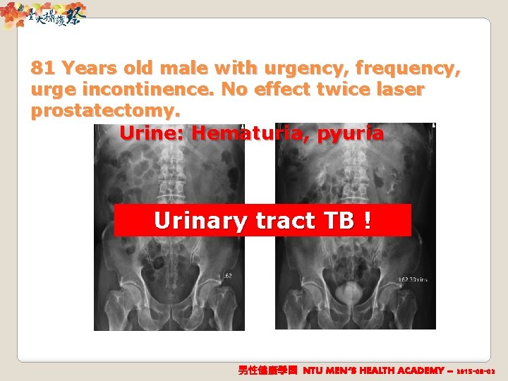 81 Years old male with urgency, frequency, urge incontinence. No effect twice laser prostatectomy.