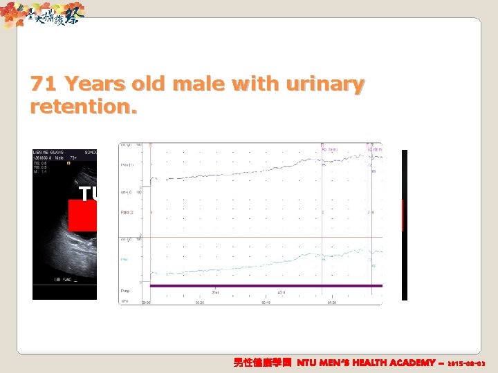 71 Years old male with urinary retention. TURP: Still Urinary Retention ! 男性健康學園 NTU
