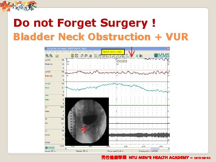 Do not Forget Surgery ! Bladder Neck Obstruction + VUR 男性健康學園 NTU MEN‘S HEALTH