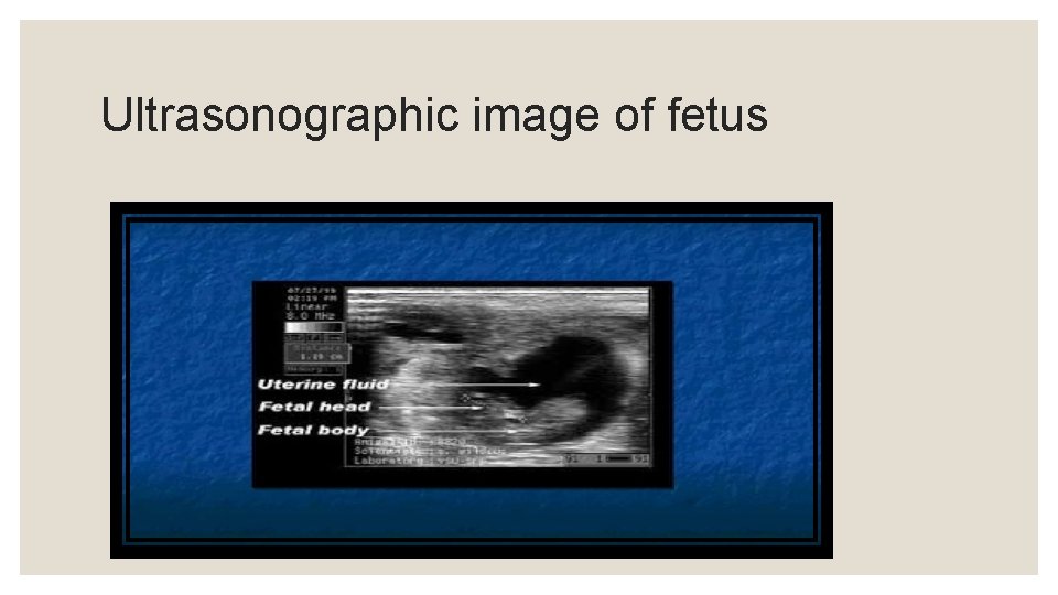 Ultrasonographic image of fetus 