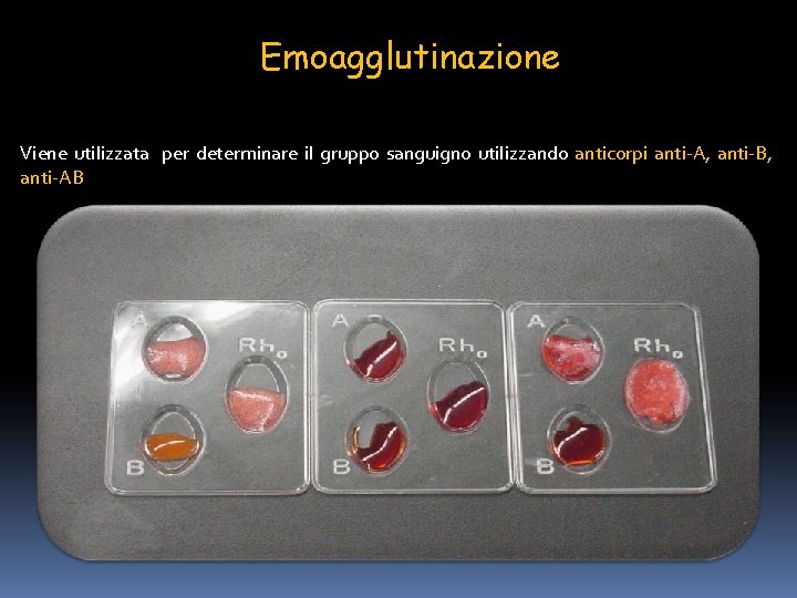 Emoagglutinazione Viene utilizzata per determinare il gruppo sanguigno utilizzando anticorpi anti-A, anti-B, anti-AB 