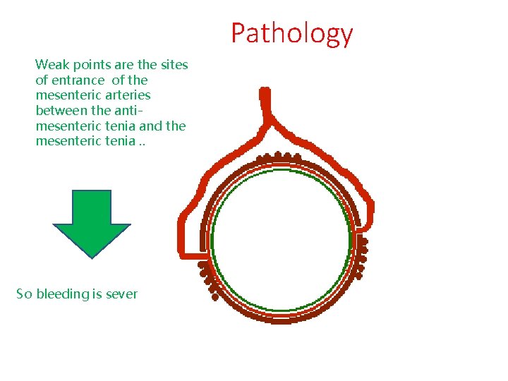 Pathology Weak points are the sites of entrance of the mesenteric arteries between the