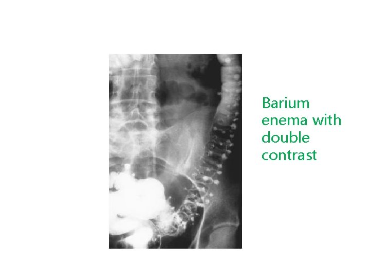 Barium enema with double contrast 