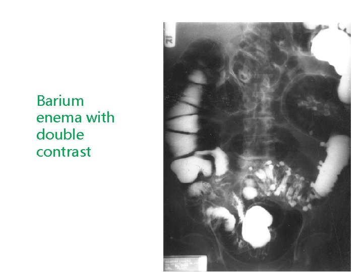 Barium enema with double contrast 