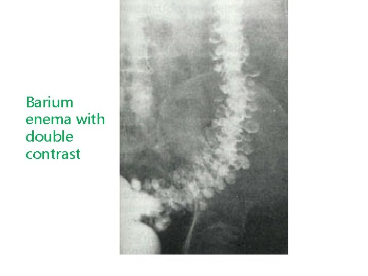 Barium enema with double contrast 