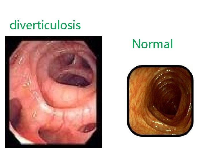 diverticulosis Normal 