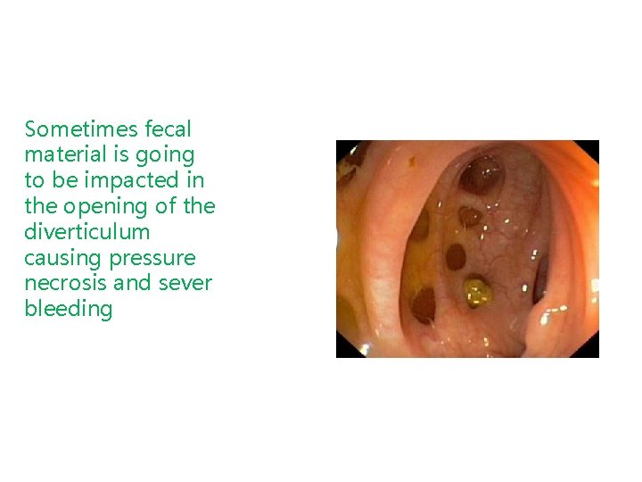 Sometimes fecal material is going to be impacted in the opening of the diverticulum