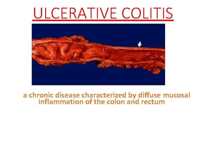 ULCERATIVE COLITIS a chronic disease characterized by diffuse mucosal inflammation of the colon and