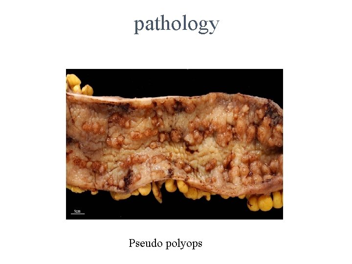 pathology Pseudo polyops 