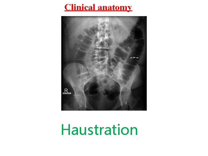 Clinical anatomy Haustration 