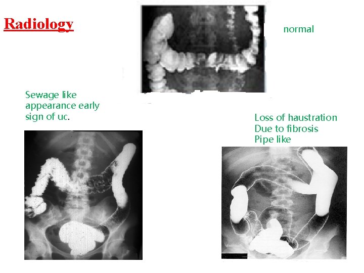 Radiology Sewage like appearance early sign of uc. normal Loss of haustration Due to