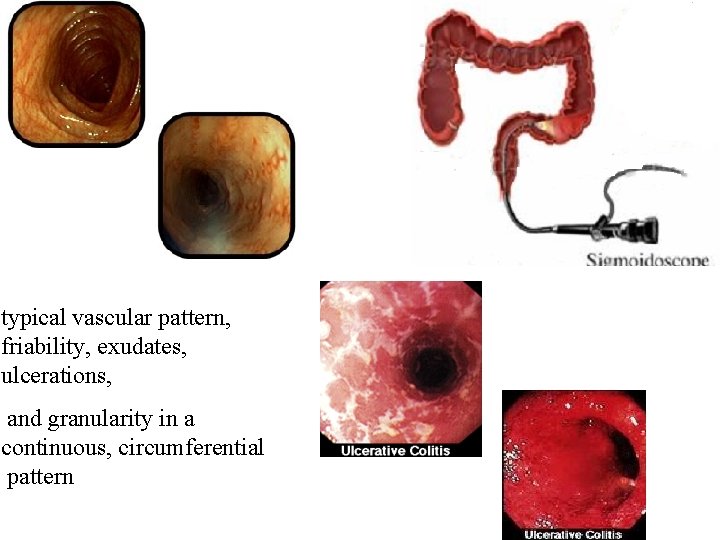 typical vascular pattern, friability, exudates, ulcerations, and granularity in a continuous, circumferential pattern 