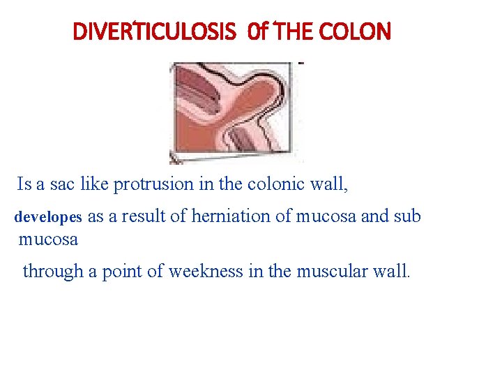 DIVERTICULOSIS 0 f THE COLON Is a sac like protrusion in the colonic wall,