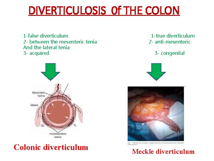 DIVERTICULOSIS 0 f THE COLON 1 -false diverticulum 2 - between the mesenteric tenia