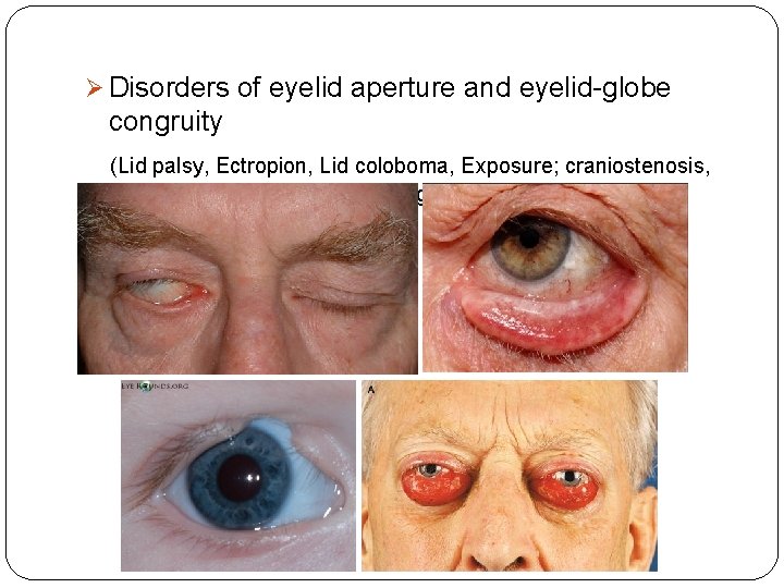 Ø Disorders of eyelid aperture and eyelid-globe congruity (Lid palsy, Ectropion, Lid coloboma, Exposure;