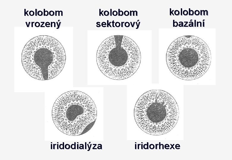 kolobom vrozený kolobom sektorový iridodialýza kolobom bazální iridorhexe 