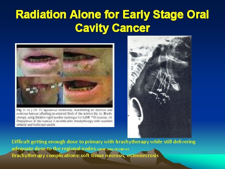Radiation Alone for Early Stage Oral Cavity Cancer Difficult getting enough dose to primary Radiation Alone for Early Stage Oral Cavity Cancer Difficult getting enough dose to primary