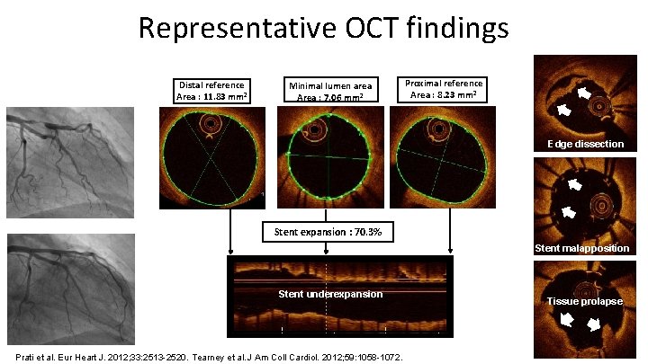 Representative OCT findings Distal reference Area : 11. 83 mm² Minimal lumen area Area