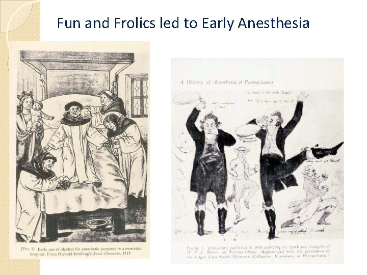 Fun and Frolics led to Early Anesthesia 