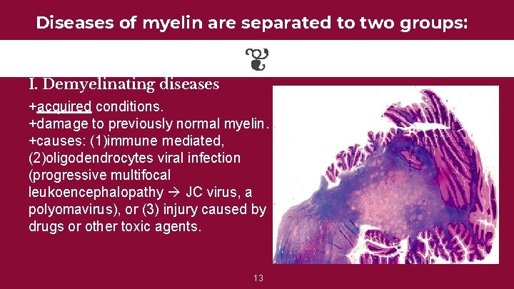 Diseases of myelin are separated to two groups: I. Demyelinating diseases +acquired conditions. +damage