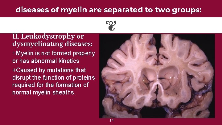 diseases of myelin are separated to two groups: II. Leukodystrophy or dysmyelinating diseases: +Myelin