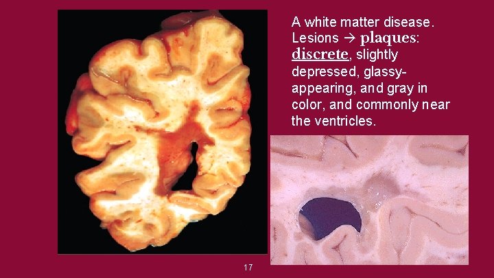 A white matter disease. Lesions plaques: discrete, slightly depressed, glassyappearing, and gray in color,