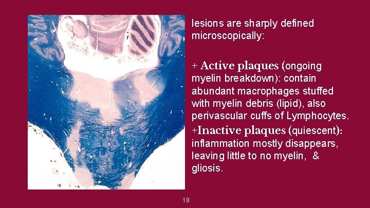 lesions are sharply defined microscopically: + Active plaques (ongoing myelin breakdown): contain abundant macrophages