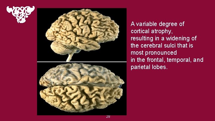 A variable degree of cortical atrophy, resulting in a widening of the cerebral sulci