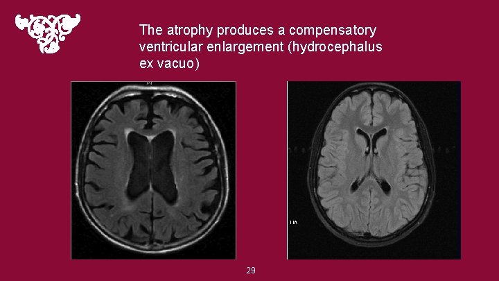 The atrophy produces a compensatory ventricular enlargement (hydrocephalus ex vacuo) 29 