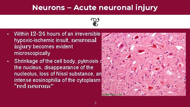 Neurons – Acute neuronal injury ▪ ▪ Within 12 -24 hours of an irreversible