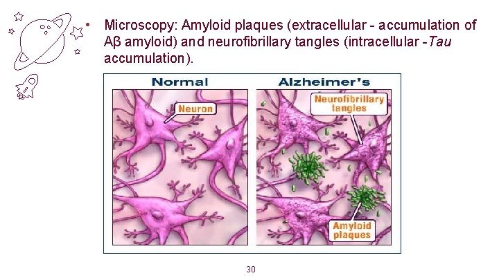  • Microscopy: Amyloid plaques (extracellular - accumulation of Aβ amyloid) and neurofibrillary tangles