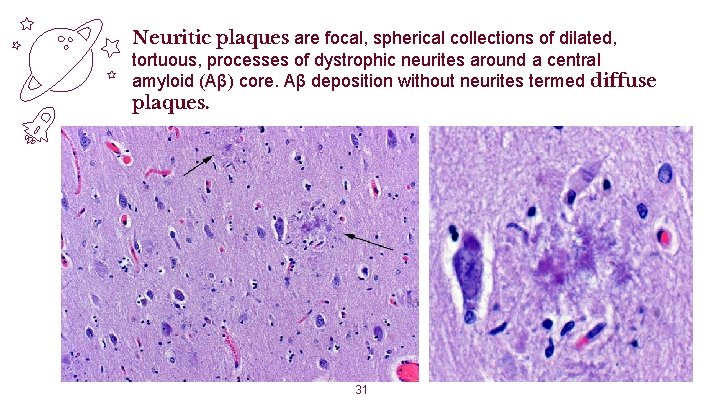 Neuritic plaques are focal, spherical collections of dilated, tortuous, processes of dystrophic neurites around