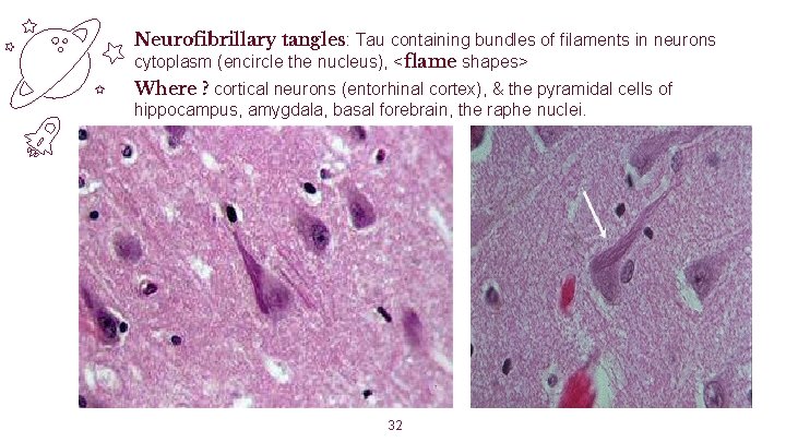 Neurofibrillary tangles: Tau containing bundles of filaments in neurons cytoplasm (encircle the nucleus), <flame