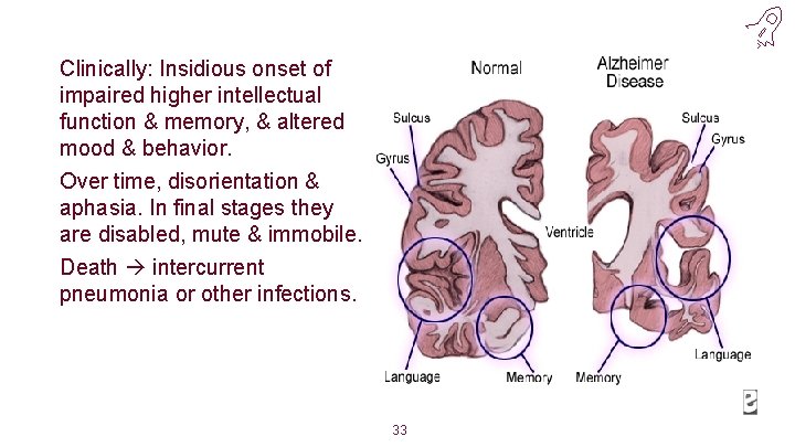 Clinically: Insidious onset of impaired higher intellectual function & memory, & altered mood &