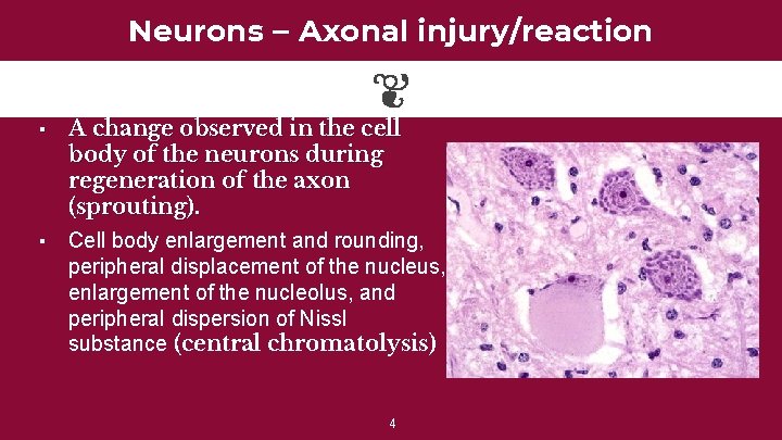 Neurons – Axonal injury/reaction ▪ ▪ A change observed in the cell body of