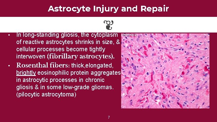 Astrocyte Injury and Repair ▪ ▪ In long-standing gliosis, the cytoplasm of reactive astrocytes