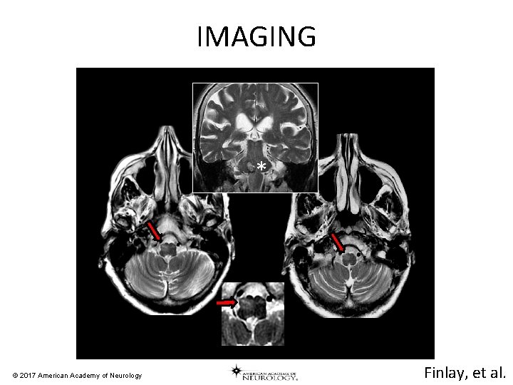 IMAGING * © 2017 American Academy of Neurology Finlay, et al. 