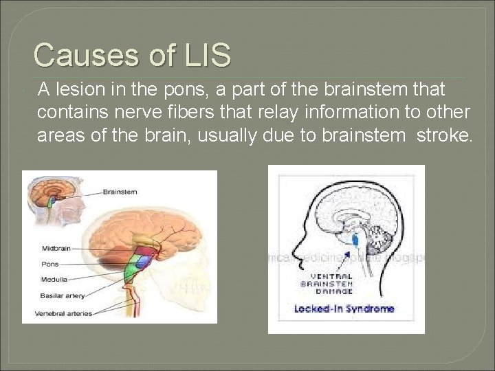 Causes of LIS A lesion in the pons, a part of the brainstem that